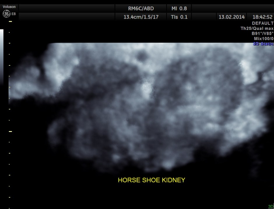 HORSE SHOE KIDNEY ADULT_15