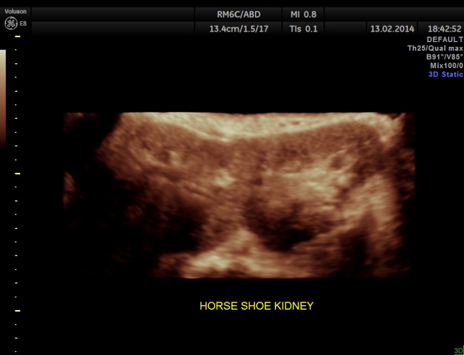 HORSE SHOE KIDNEY ADULT_17