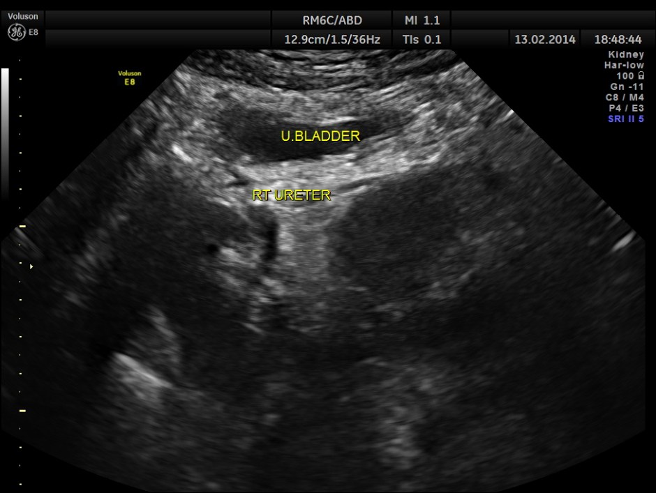HORSE SHOE KIDNEY ADULT_18