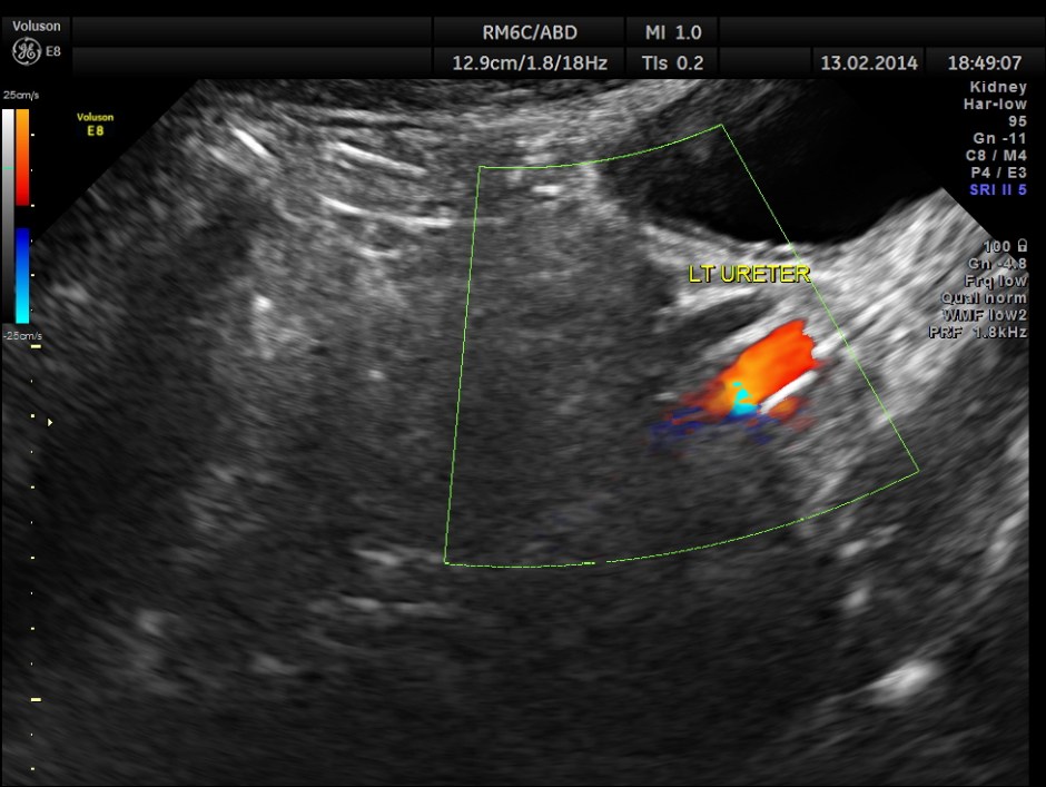 HORSE SHOE KIDNEY ADULT_19