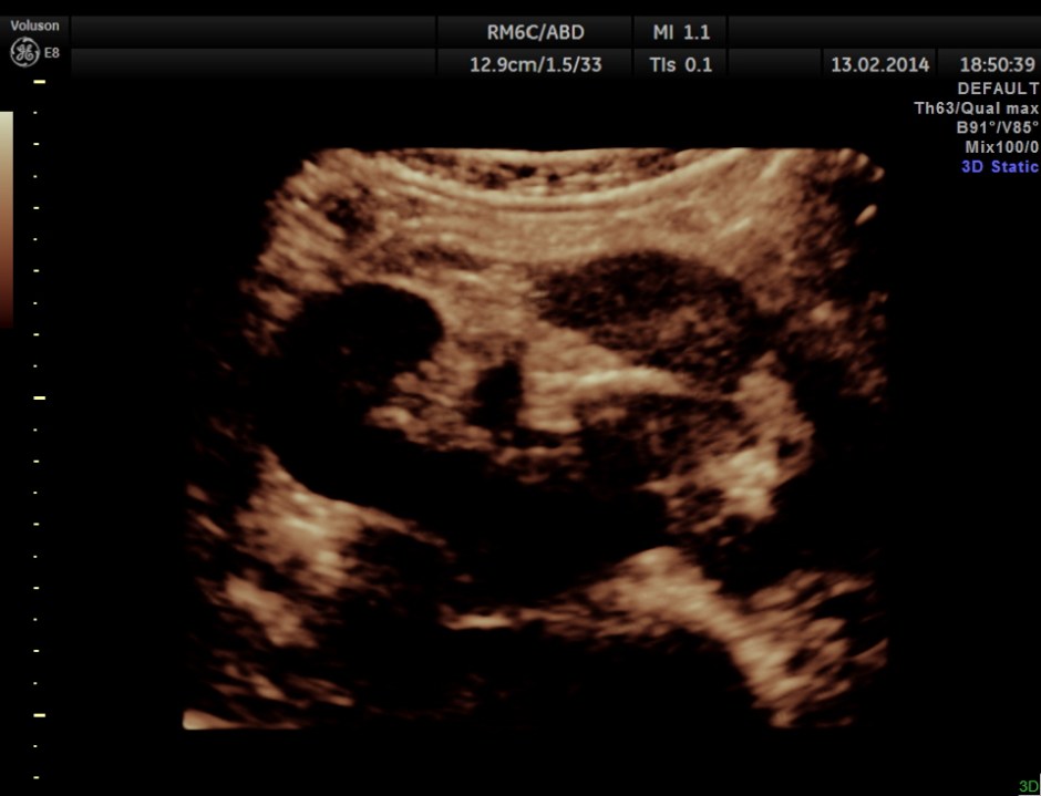 HORSE SHOE KIDNEY ADULT_20