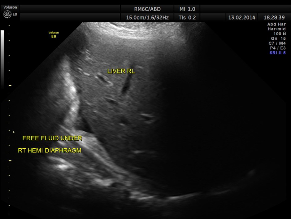 HORSE SHOE KIDNEY ADULT_3