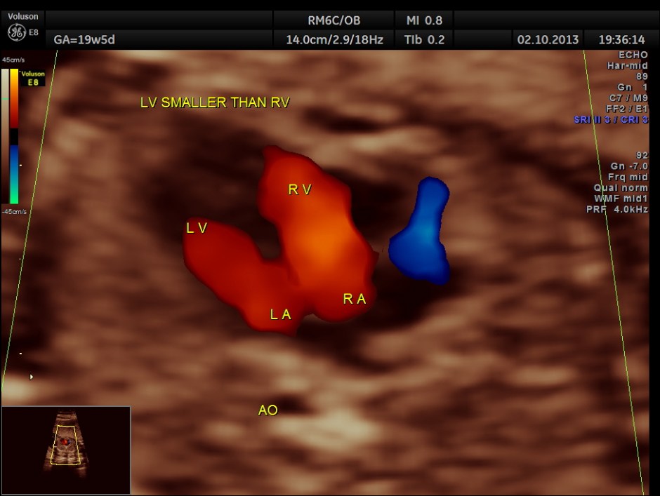 CO ARCTATION OF AO_1