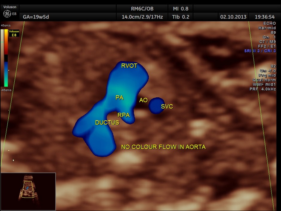 CO ARCTATION OF AO_2