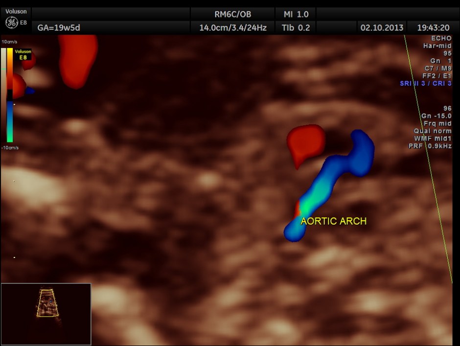 CO ARCTATION OF AO_7