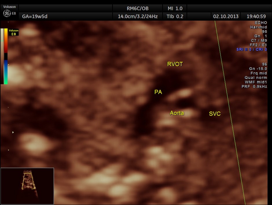 CO ARCTATION OF AO_9