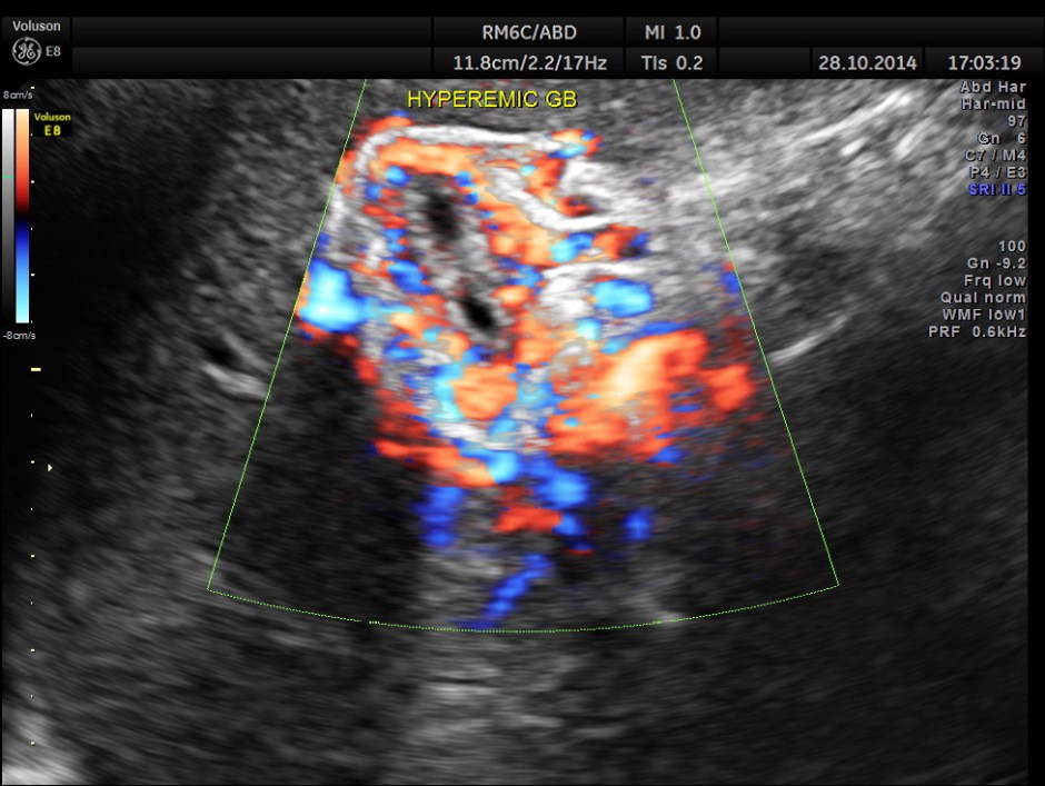 GB VARICES CIRRHOSIS_1