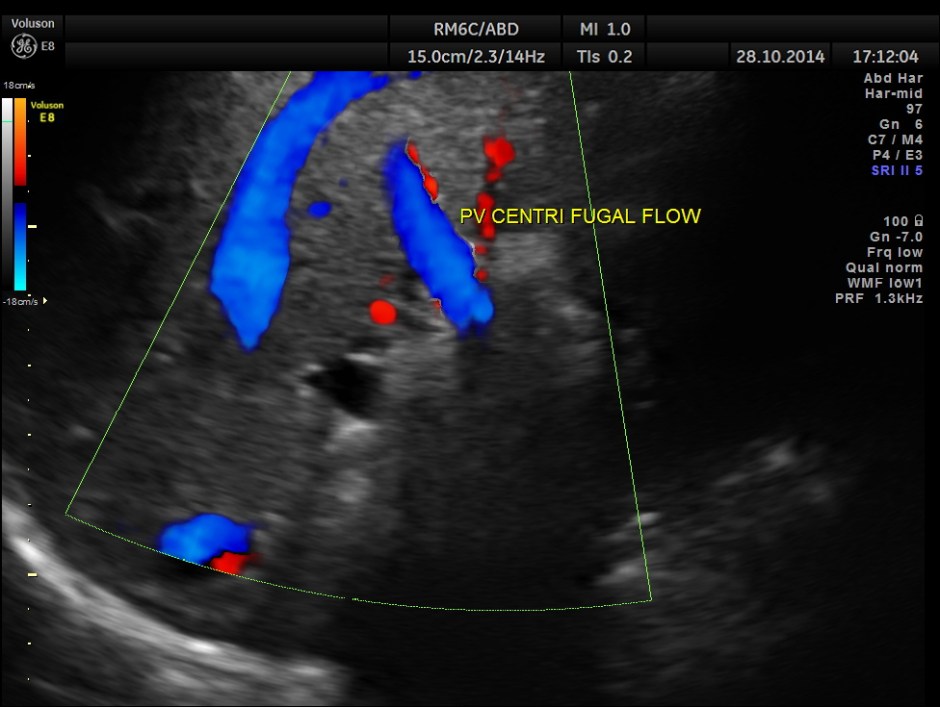 GB VARICES CIRRHOSIS_10