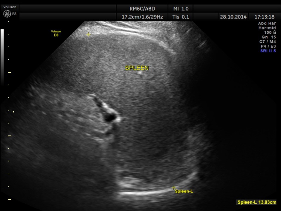 GB VARICES CIRRHOSIS_13