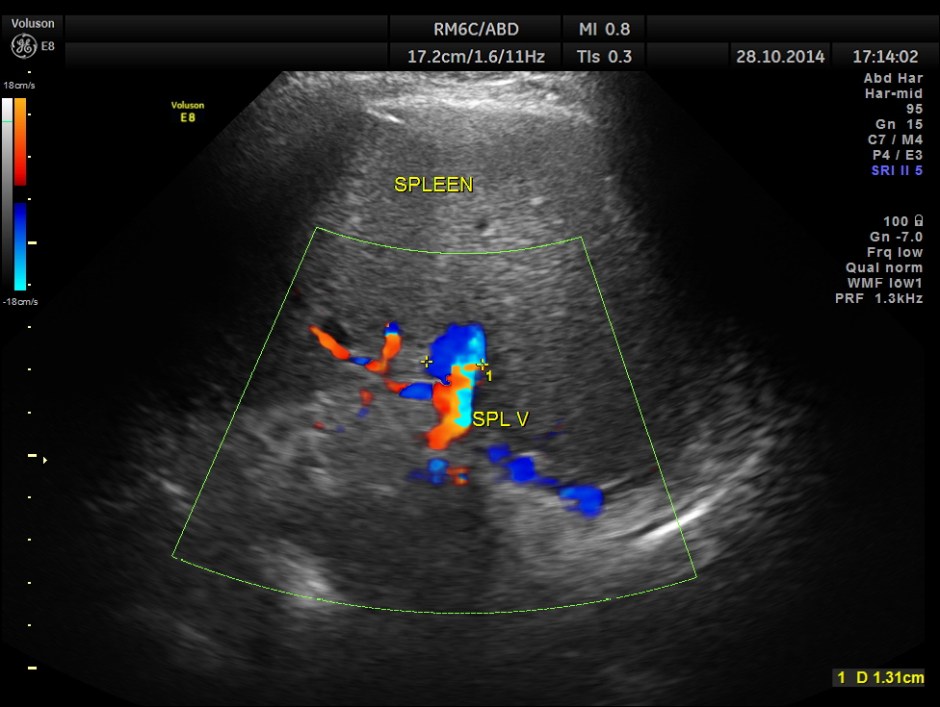 GB VARICES CIRRHOSIS_14