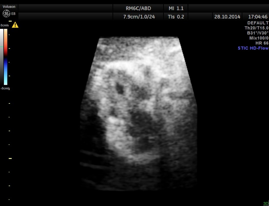 GB VARICES CIRRHOSIS_4