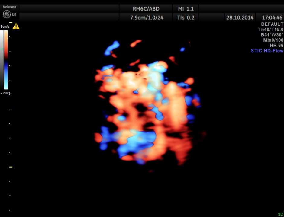 GB VARICES CIRRHOSIS_5