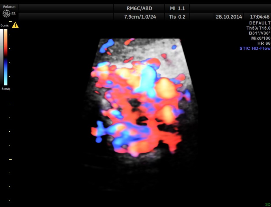 GB VARICES CIRRHOSIS_6