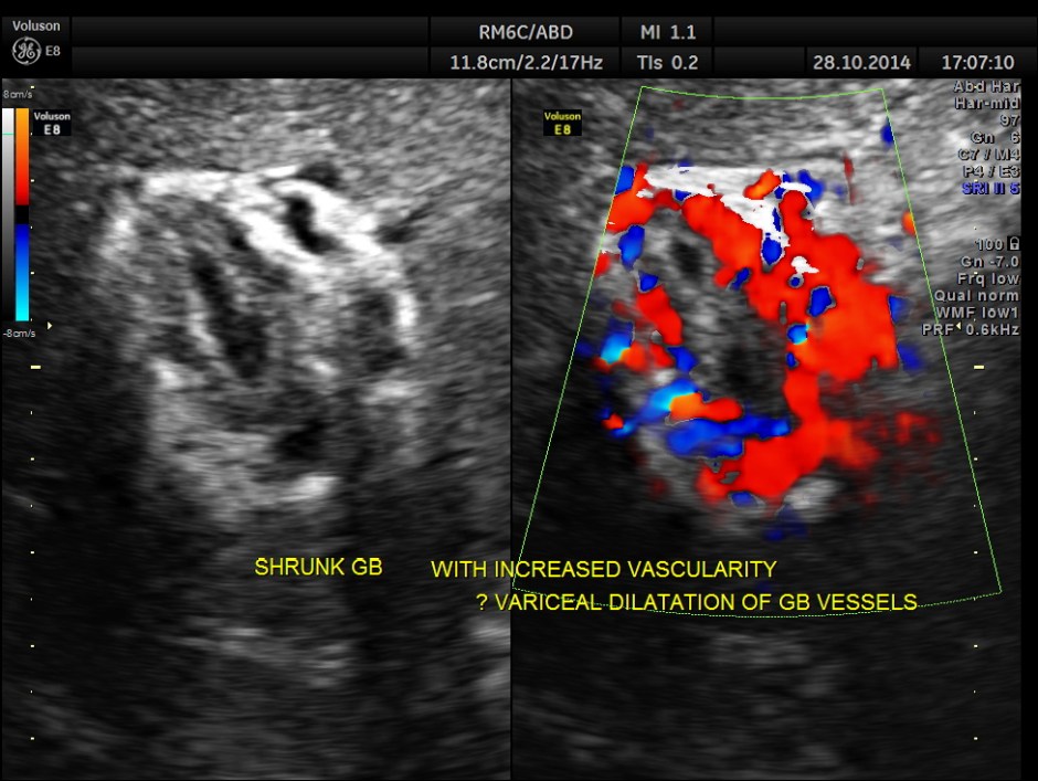GB VARICES CIRRHOSIS_7