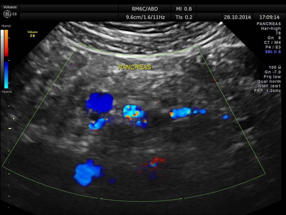 GB VARICES CIRRHOSIS_8
