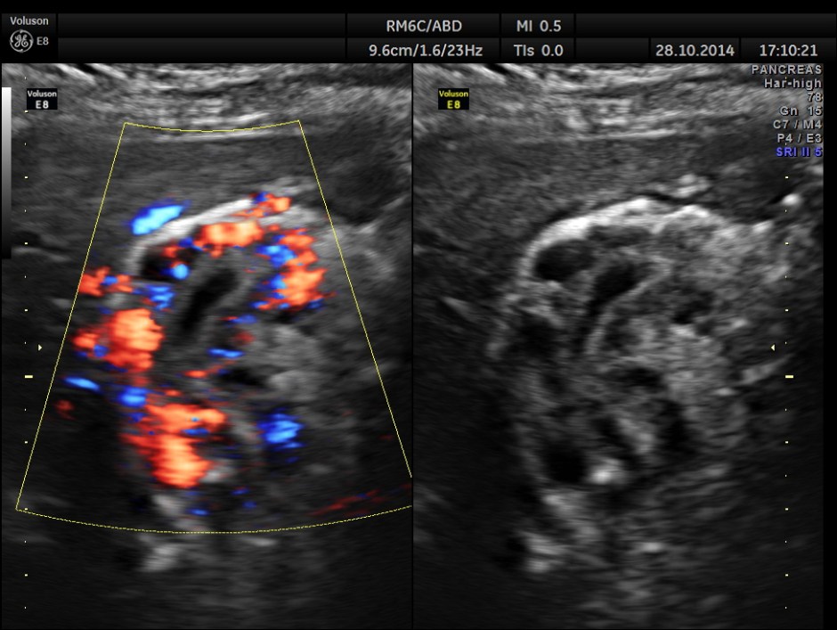 GB VARICES CIRRHOSIS_9