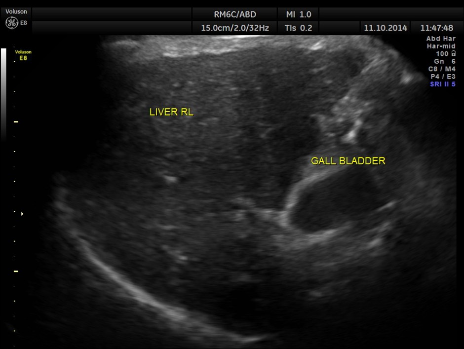 PORTAL HT LIENO RENAL VARICES_1