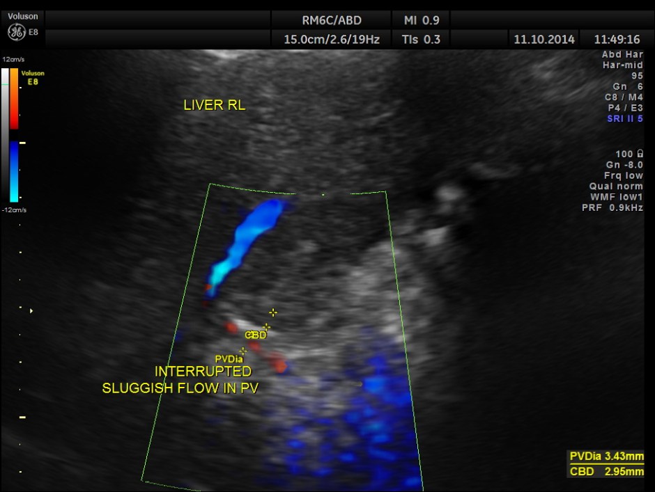 PORTAL HT LIENO RENAL VARICES_2