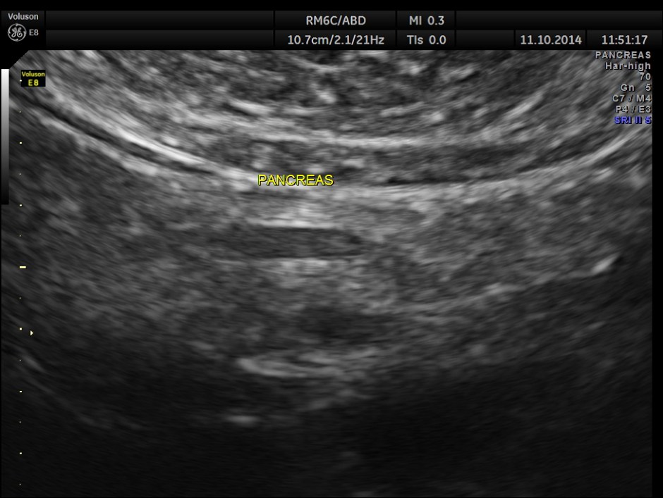 PORTAL HT LIENO RENAL VARICES_3