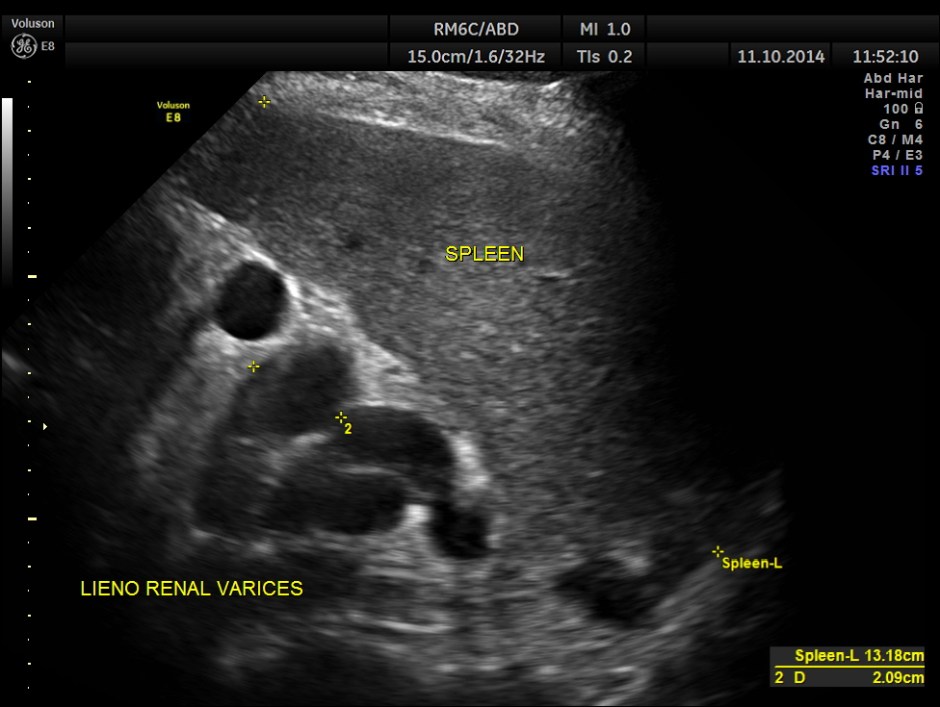 PORTAL HT LIENO RENAL VARICES_4
