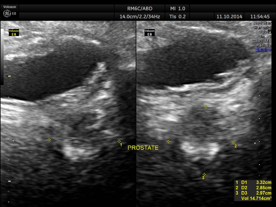 PORTAL HT LIENO RENAL VARICES_6