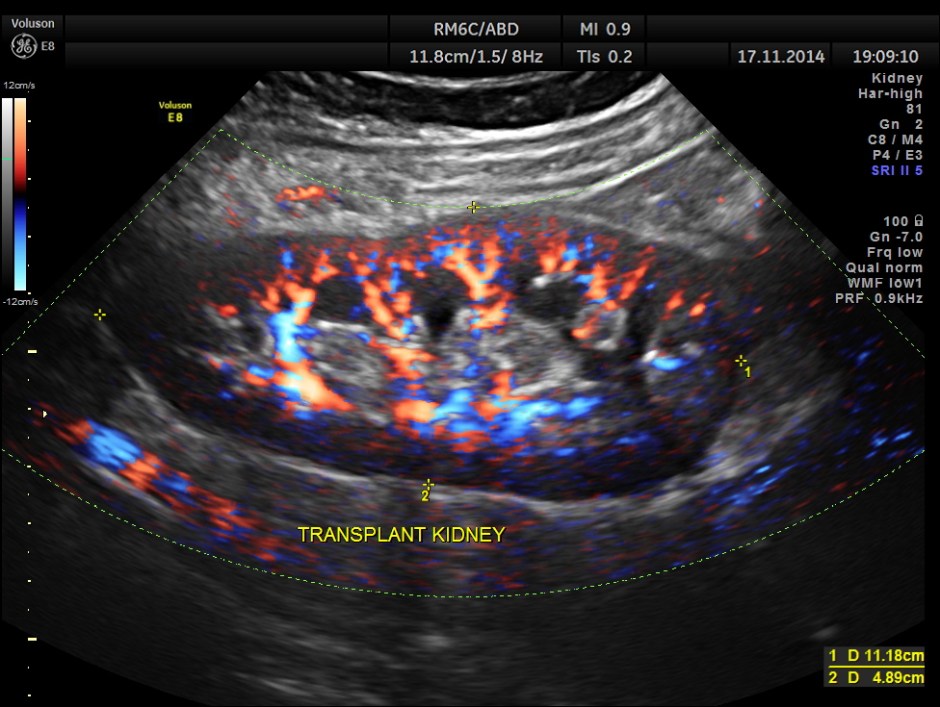 TRANSPLANT KIDNEY_1