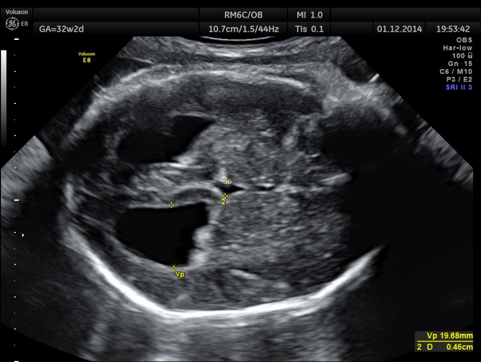 HYDROCEPHALUS NEURAL TUBE DEFECT_1