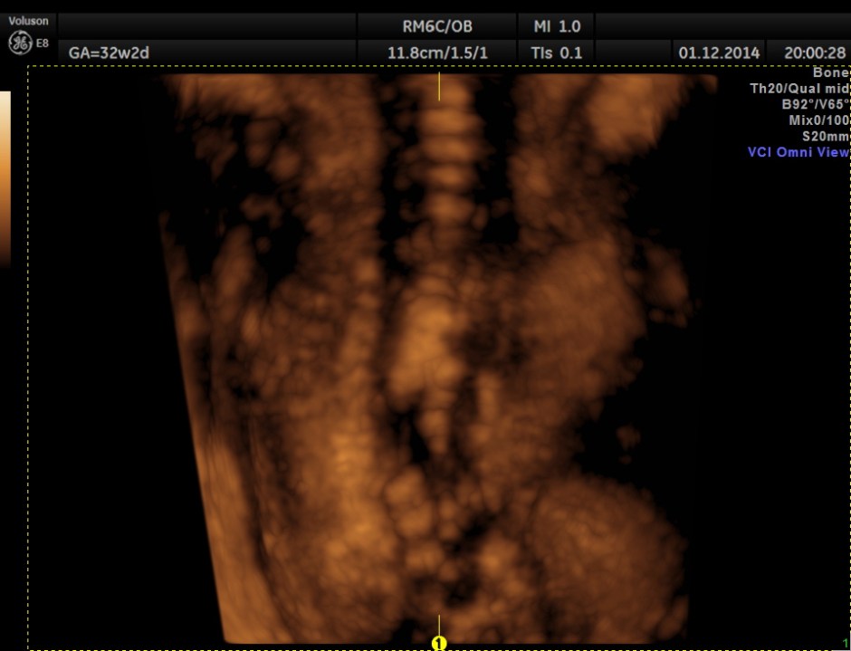 HYDROCEPHALUS NEURAL TUBE DEFECT_10