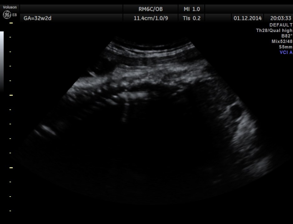 HYDROCEPHALUS NEURAL TUBE DEFECT_11