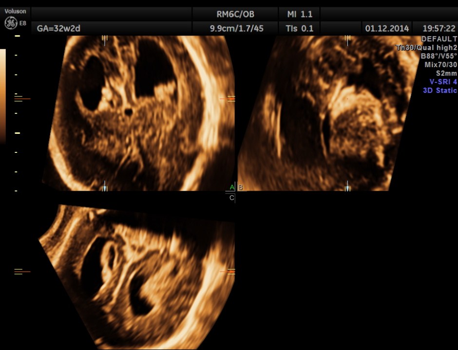HYDROCEPHALUS NEURAL TUBE DEFECT_15