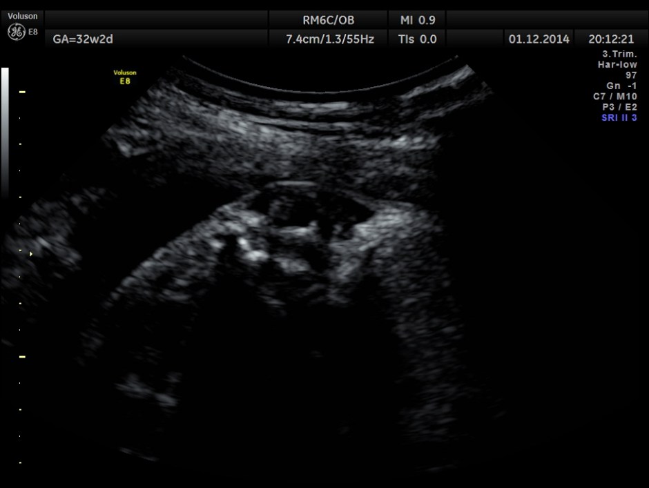 HYDROCEPHALUS NEURAL TUBE DEFECT_16