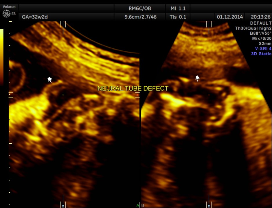 HYDROCEPHALUS NEURAL TUBE DEFECT_18