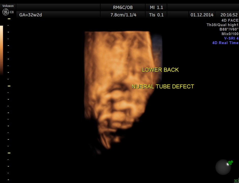 HYDROCEPHALUS NEURAL TUBE DEFECT_19