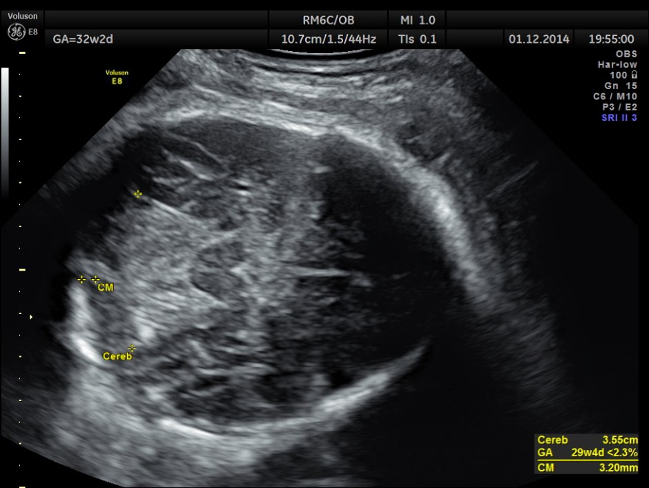 HYDROCEPHALUS NEURAL TUBE DEFECT_2