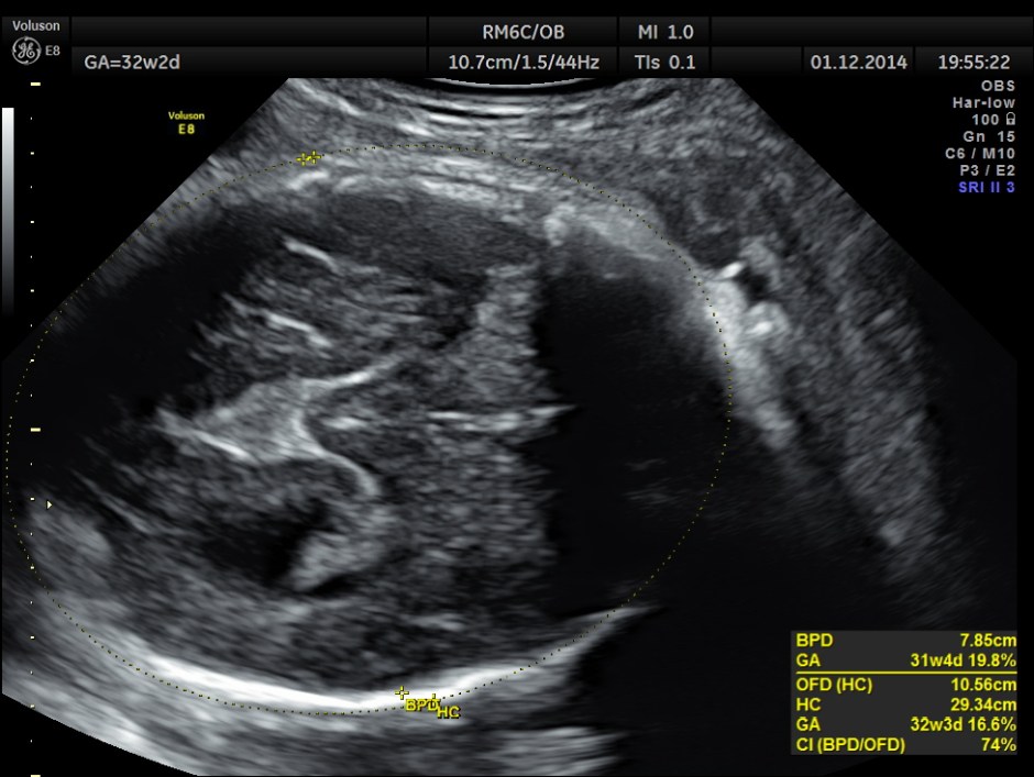 HYDROCEPHALUS NEURAL TUBE DEFECT_3