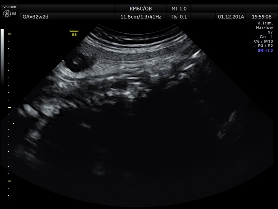 HYDROCEPHALUS NEURAL TUBE DEFECT_7