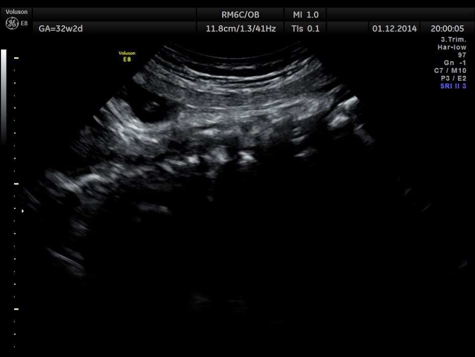 HYDROCEPHALUS NEURAL TUBE DEFECT_8