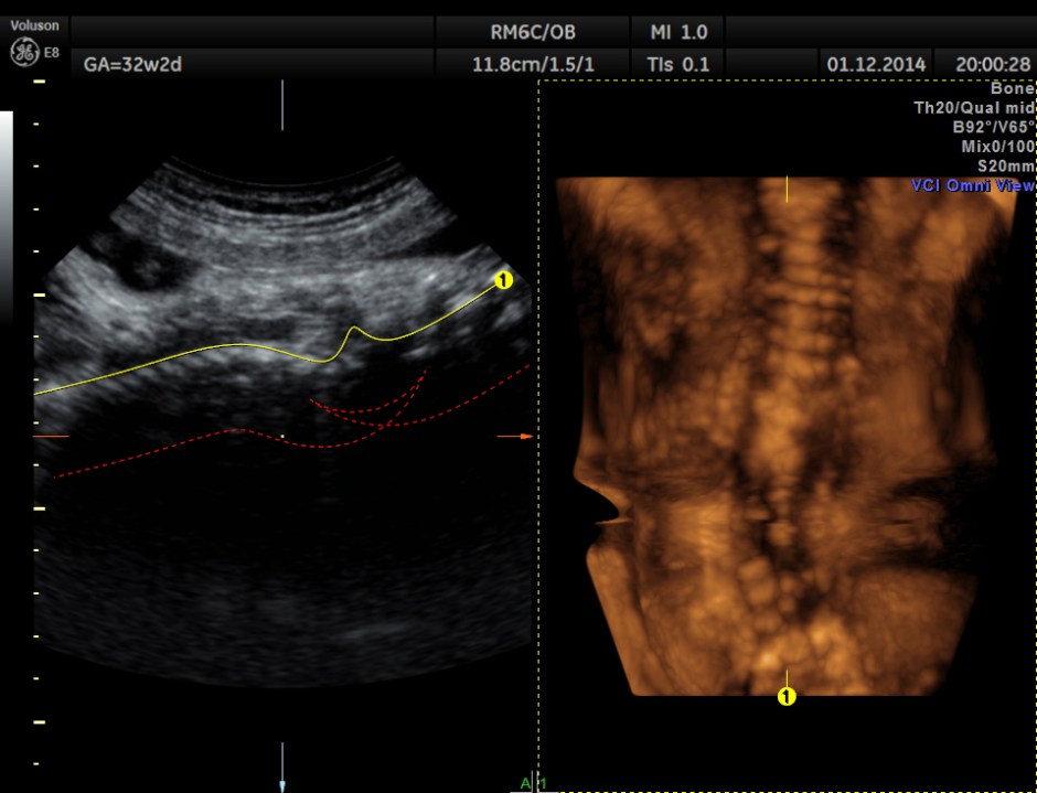 HYDROCEPHALUS NEURAL TUBE DEFECT_9