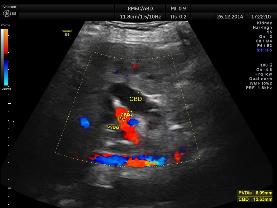 OBSTRUCTIVE JAUND CA PANC _1