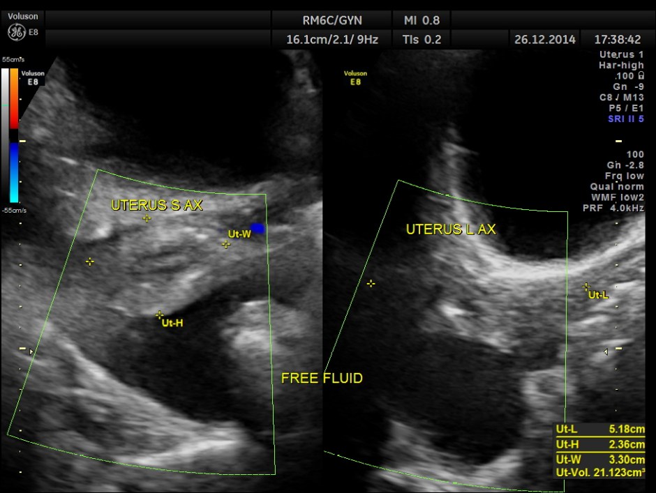 OBSTRUCTIVE JAUND CA PANC _10