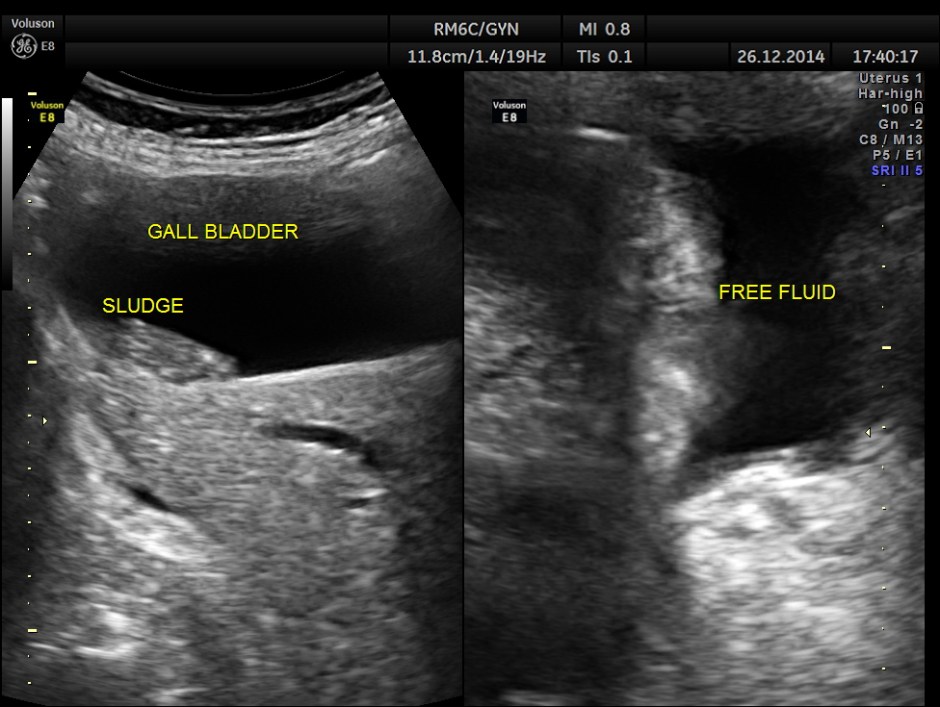 OBSTRUCTIVE JAUND CA PANC _11