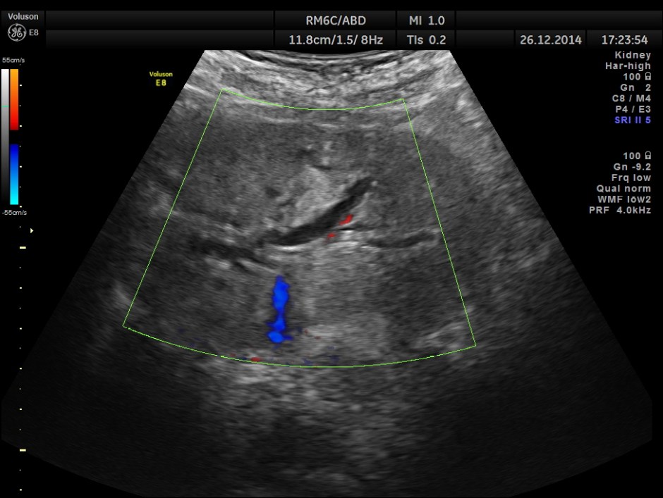 OBSTRUCTIVE JAUND CA PANC _3