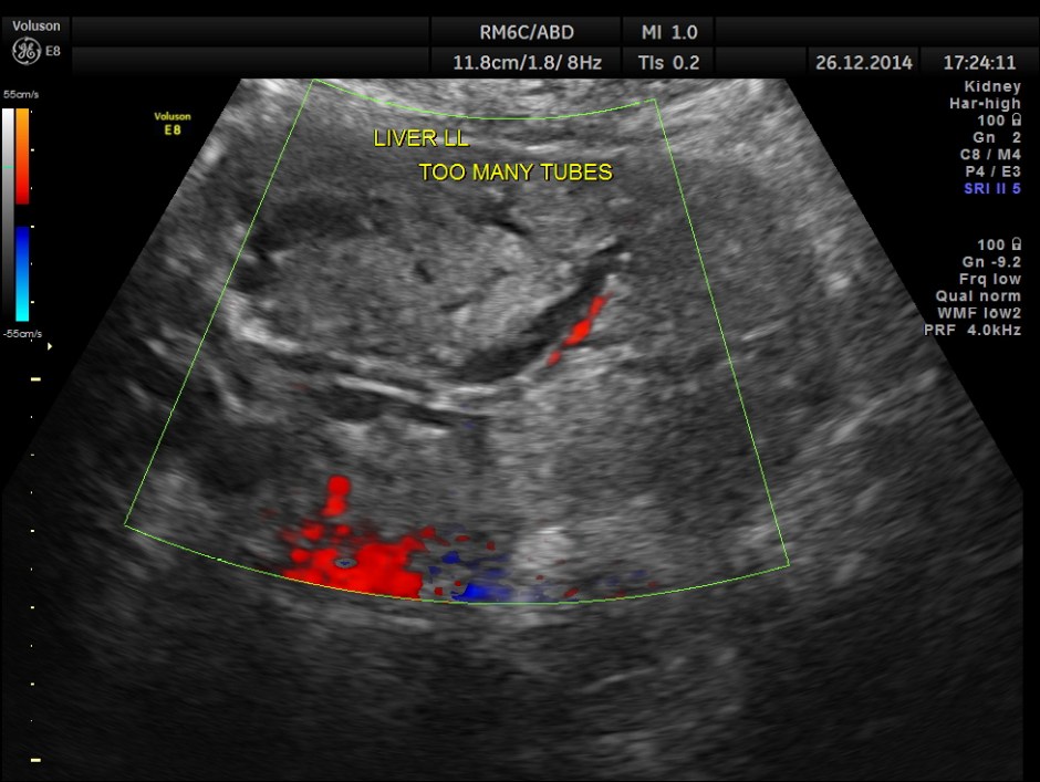 OBSTRUCTIVE JAUND CA PANC _4