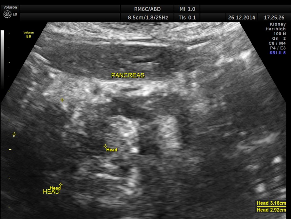 OBSTRUCTIVE JAUND CA PANC _5