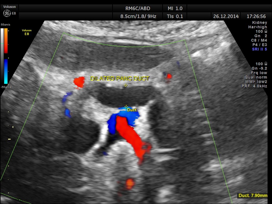 OBSTRUCTIVE JAUND CA PANC _6