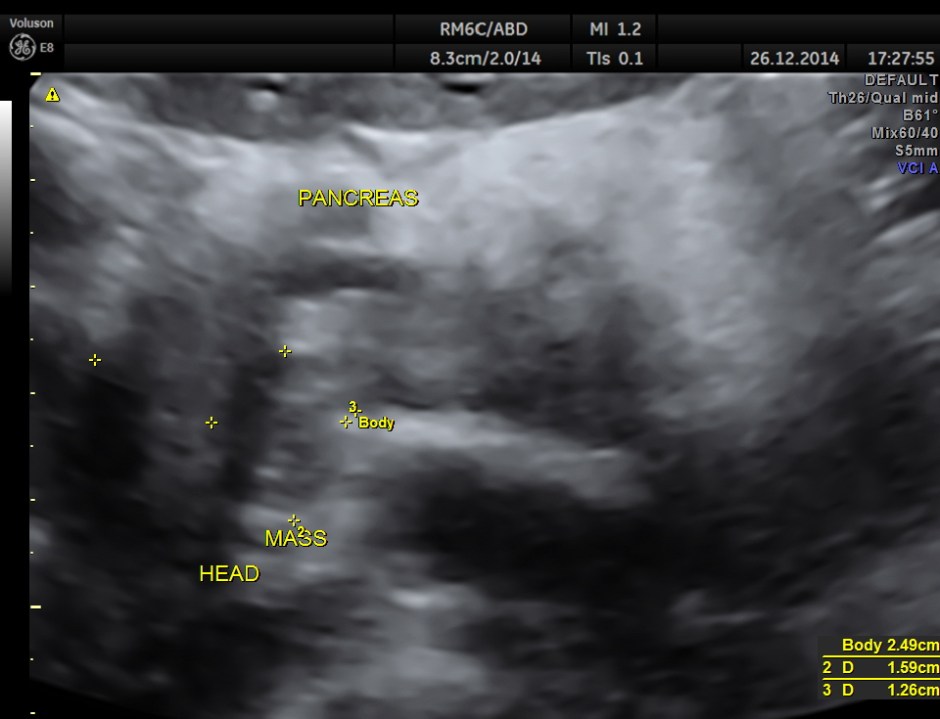 OBSTRUCTIVE JAUND CA PANC _7