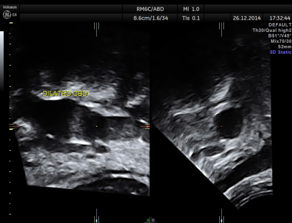 OBSTRUCTIVE JAUND CA PANC _8