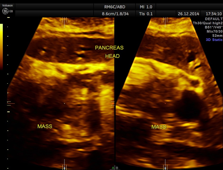 OBSTRUCTIVE JAUND CA PANC _9