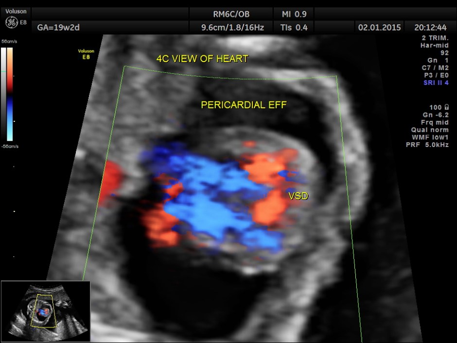 PERI EFF VSD LT HEART HYPO_15