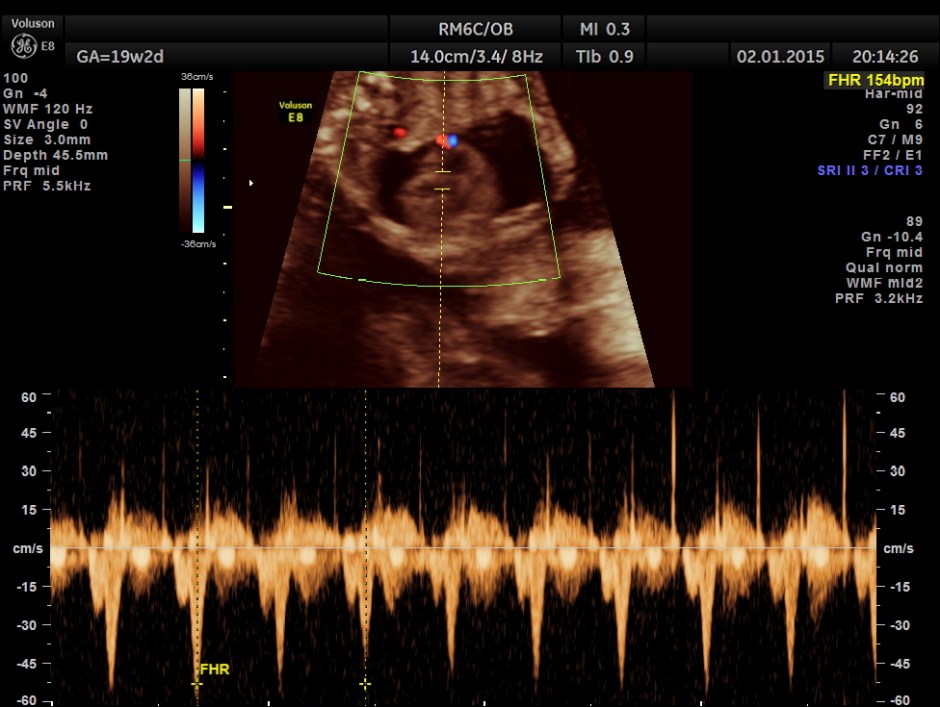 PERI EFF VSD LT HEART HYPO_17